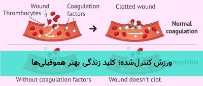 ورزش کنترل‌شده؛ کلید زندگی بهتر هموفیلی‌ها