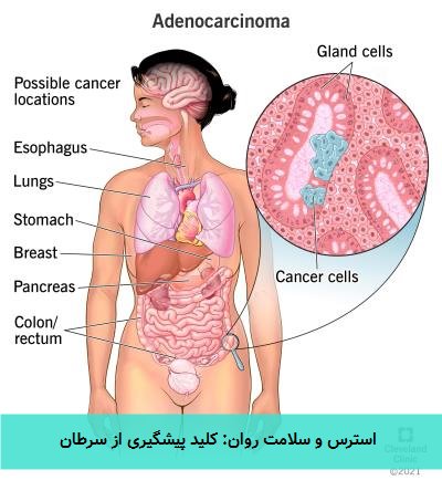  استرس و سلامت روان: کلید پیشگیری از سرطان 